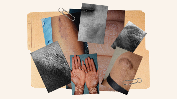 11 Common Skin Conditions on Dark Skin and How to Treat Them