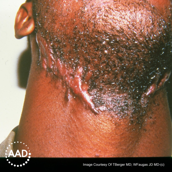 Keloid scar on neck on a Black man