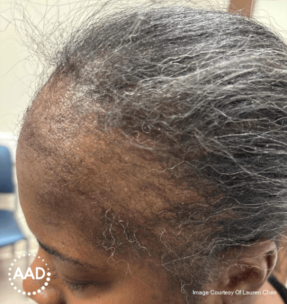 Woman with traction alopecia